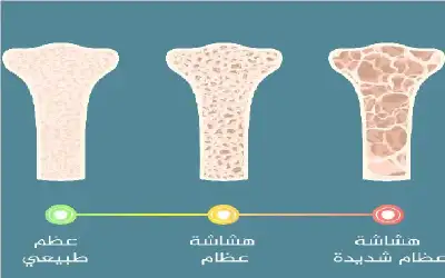 امرأة نيسان ـ دور مهم للعلاج الهرموني في حماية
